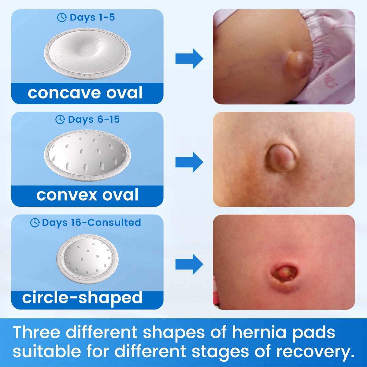 VELPEAU Baby Belly Hernia Belt with 3 Compression Pads, Umbilical Hernia Band Belly Button Abdominal Binder for Infant Newborn
